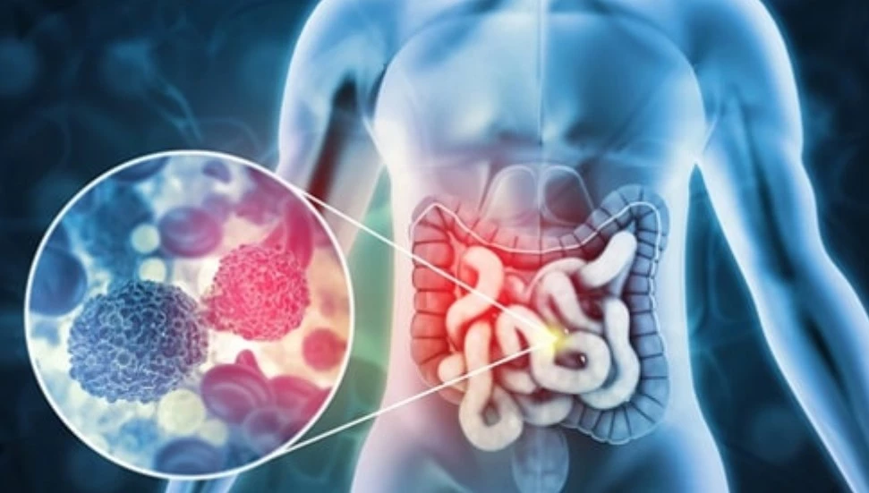 KTTB kolorektal kansere erken evrede müdahalenin önemine işaret etti